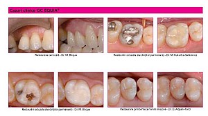 GC Equia capsule A2 50 buc/cutie - imagine 2