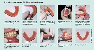 Gc Tissue Conditioner 1-1 - imagine 2