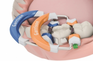GR Inel Composi-Tight 3D Fusion molar portocaliu #FX500-1 - imagine 2