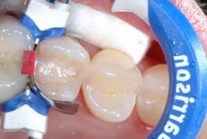 GR Inel Composi-Tight 3D Fusion premolar albastru #FX400-1 - imagine 2