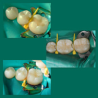 Pene Interdentare Asortate Composi-Tight 3D Fusion FXK4 400 buc/kit GARRISON - imagine 2