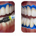 Diga Lichida Rubber-Dam Liquid seringa 1.2ml CERKAMED