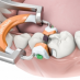 GR Inel Composi-Tight 3D Fusion molar portocaliu #FX500-1