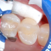 GR Inel Composi-Tight 3D Fusion premolar albastru #FX400-1